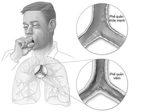 bronchial spasms|Bronchospasm: Symptoms, Causes, and Treatment.